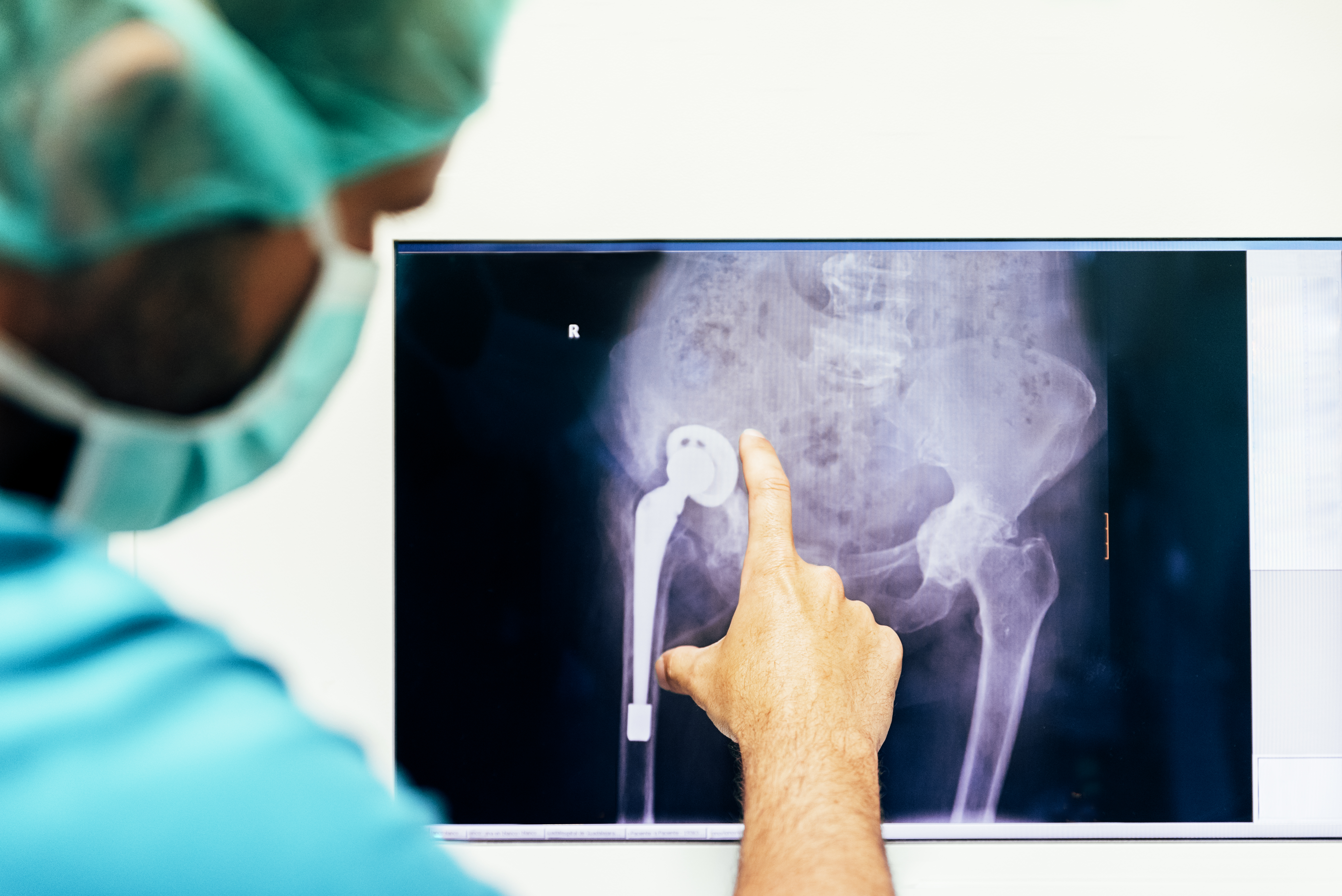 Knee Replacement in Bangalore